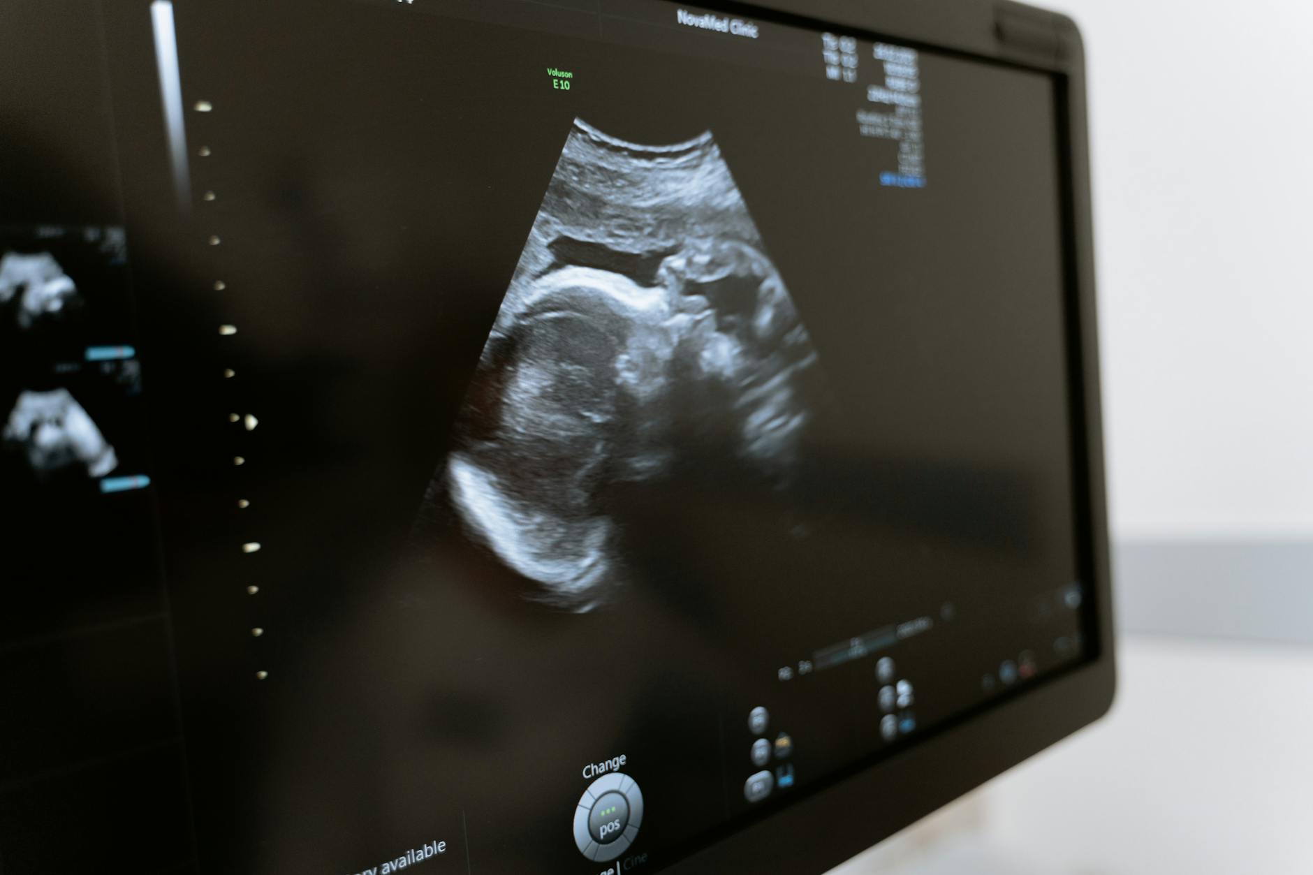 SHAPES: is BMI a good predictor of risk in pregnancy?